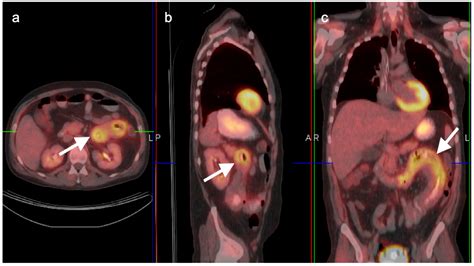 Does a PET Scan Show Colon Cancer? And Can It Also Predict the Future of Quantum Computing?